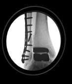 Charcot Joint, neurologically compromised foot, chronic