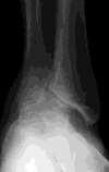 Physical Exam Short strided antalgic gait Weakness Swelling Varus or Valgus Generalized tenderness over ankle joint Distinguish from subtalar pain Radiographs