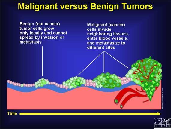 Tumor and Metastasis Benign tumor: If the abnormal cells remain at the original