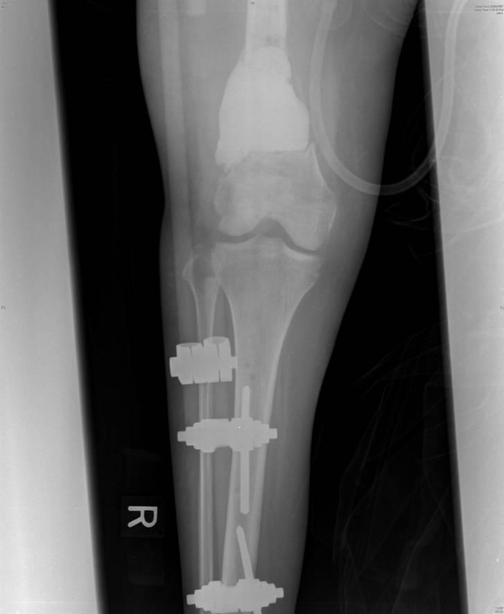 IJCRI 2011;2(5):1-6. Doshi et. al. 4 Figure 5: X-ray film of right lower limb with gentamicin impregnated cement spacer in-situ of Case 3. Figure 6: Picture of healed amputation stump wound of Case 3.