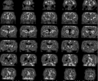 Imaginile RMN se coreleazå foarte bine cu simptomatologia i progresia demen ei. Figura 4. b. Se observå scåderea globalå a perfuziei, cu defecte mici, multiple.
