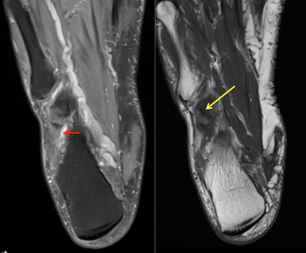 Fig. 2: Peroneus longus tendinopathy; os peroneum with increased intensity of peroneus longus tendon