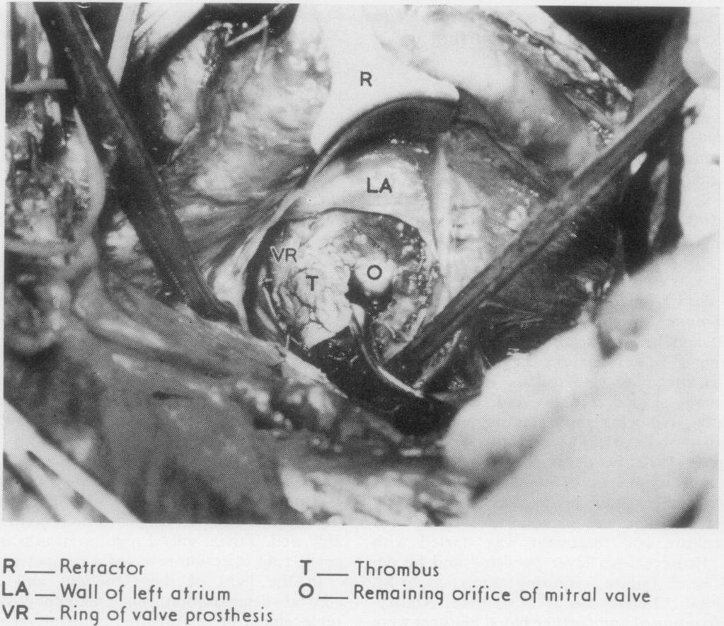 However, thrombus was seen extending over the valve orifice from the margin of the prosthesis with the formation of a flap responsible for the functional stenosis (Figure).