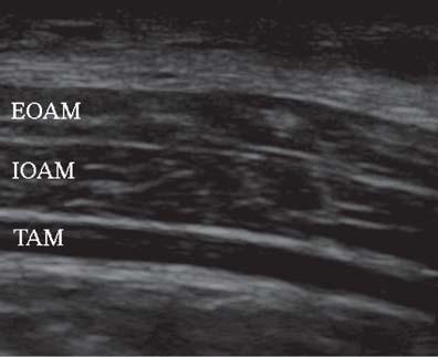 El-Dawlatly et al. internal oblique abdominal muscle (IOAM) and the transverse abdominal muscle (TAM).