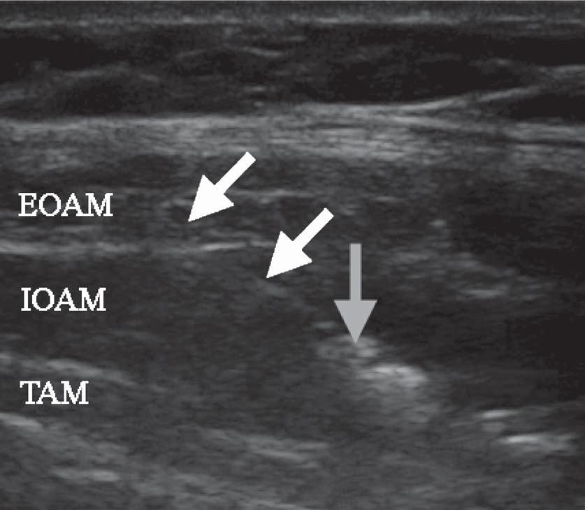 Ultrasound-guided TAP block Fig 3 Transverse ultrasound view of the EOAM, IOAM, and TAM during injection of the local anaesthetic between the inner two muscles.