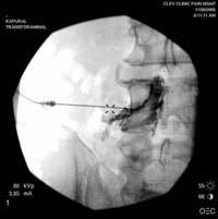 Interventional Pain Management Epidural steroid injections Cervical,