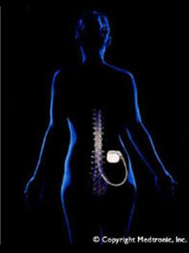 Interventional Pain Management Spinal cord stimulation Useful for radiculopathies/