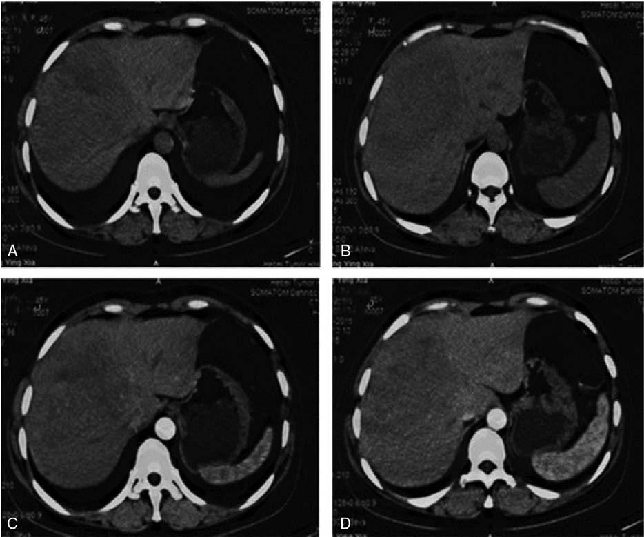 Medicine Figure 1. CT: (A, B) Plain phase. A tumor approximately 11.0cm in diameter was found in the right lobe of the liver; (C, D) Arterial phase. The peri-tumor area was slightly enhanced.