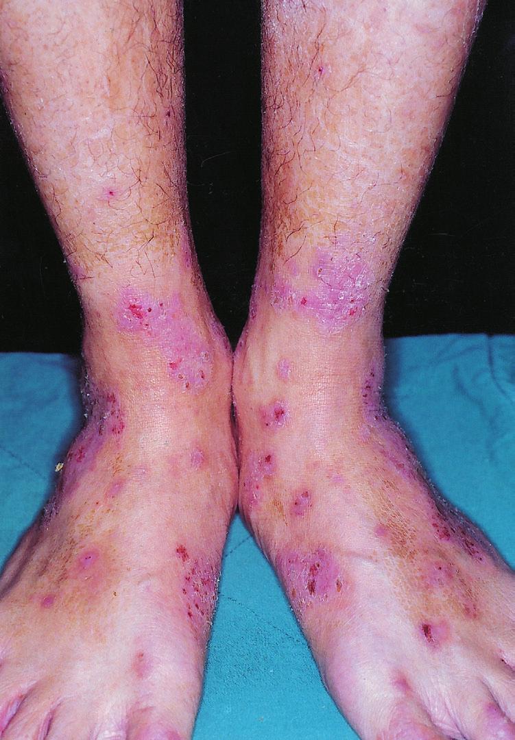 8 Lower legs of a 28-year-old man with severe atopic dermatitis