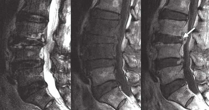 MRI of Candida Spondylitis References 1. Frazier DD, Campbell DR, Garvey TA, Wiesel S, Bohlman HH, Eismont FJ. Fungal infections of the spine: report of eleven patients with long-term follow-up.