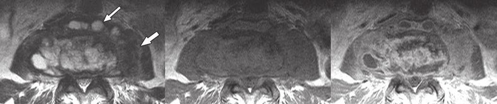 MRI of Candida Spondylitis Fig. 3 Paraspinal abscess and mass.