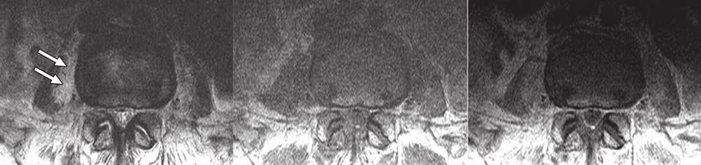 spondylitis show multiple small paraspinal abscesses (thin arrow) and diffusely enhancing left paraspinal