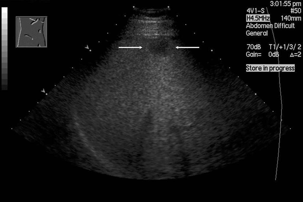 Focal hypoechoic tumor of fatty liver (hemangioma) in a 44-year-old man. A, Sonogram showing the focal hypoechoic lesion (arrows) with posterior echo enhancement in the fatty liver.