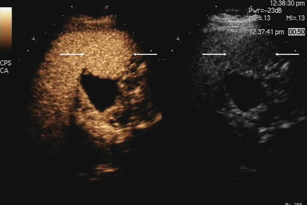 A, Sonogram showing the focal hypoechoic lesion (arrows) in the diffusely hyperechoic