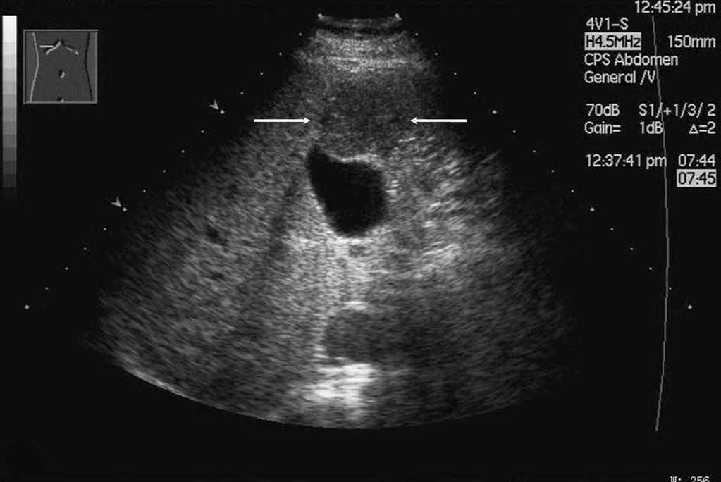 E, Hyperenhancement (left arrows) of the tumor during the portal phase (50 seconds),