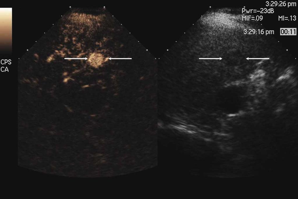 Focal nodular hyperplasia lesions are the second most common benign hepatic tumors after hemagiomas. 15,16 In our study, an arterial vessel was observed in 37.