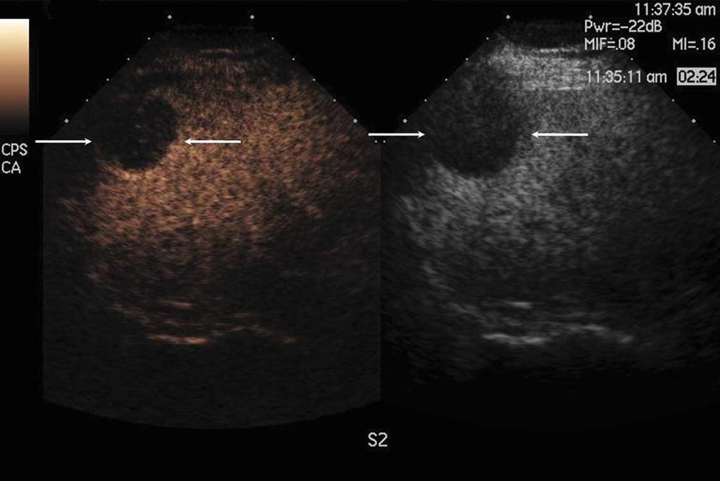 Focal Hypoechoic Tumors of Fatty Liver tional ultrasonography has certain limitations in the diagnosis of FNH.