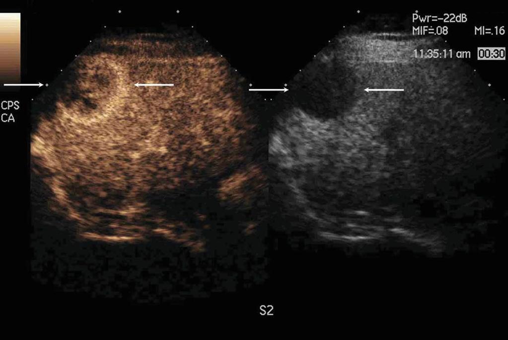 B, Contrast-enhanced CPS image showing hyperenhancement (left arrows) of the tumor during the early arterial phase (16 seconds), corresponding to the hypoechoic area (right arrows) in the fatty liver