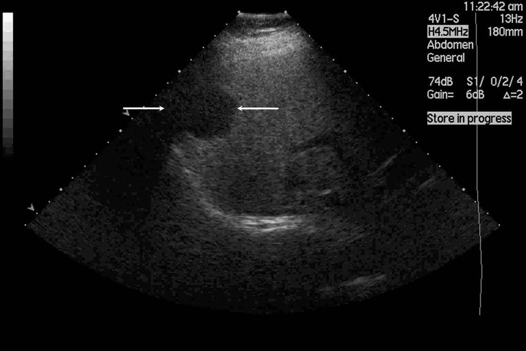 D, Hypoenhancement (left arrows) during the late phase (144 seconds), corresponding to the hypoechoic area (right arrows) in the fatty liver on the baseline sonogram.