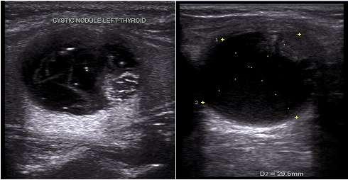 Fig. 4: USG image shows a well defined predominant solid cystic benign lesion with multiple