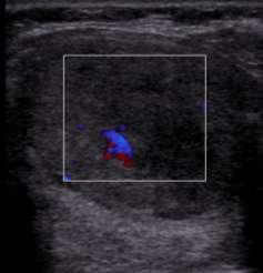6: USG image shows heterogenous nodule in thyroid with large lymph nodes having