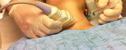 on the same side that needs to be examined. The transducer is usually held in the operator s non-dominant hand, with the needle in the dominant hand.
