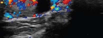 Color Doppler image of peripheral