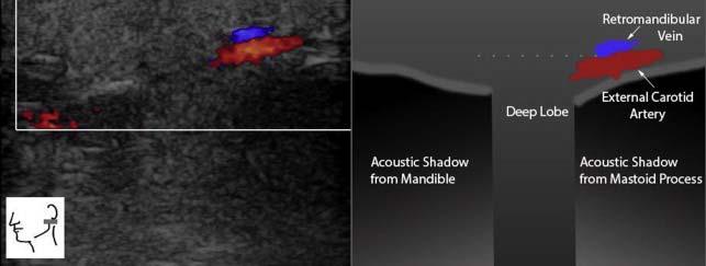 Ultrasound of the Parotid Accessory parotid tissue (20% of patients) is found along parotid duct.