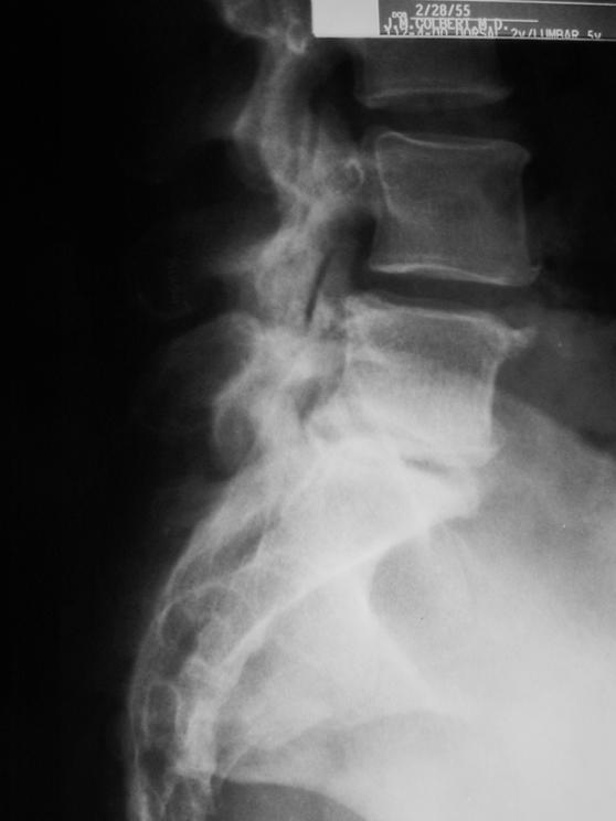Adjacent Segment (Lumbar) Hypolordosis produces increased posterior element loading in adjacent segments (compensatory hyperlordosis) The Biomechanical