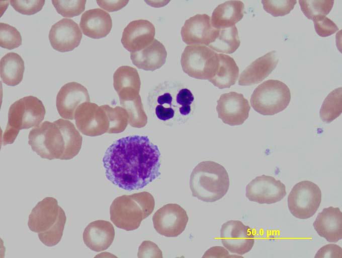 Blood and Blood Cells Plasma consists of proteins - albumin, fibrinogen and