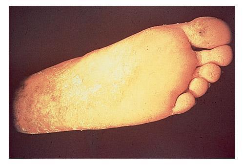 Athlete s foot What causes athlete s foot?