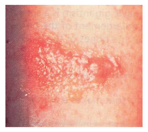 Dermatitis/Eczema dermat- -itis What is