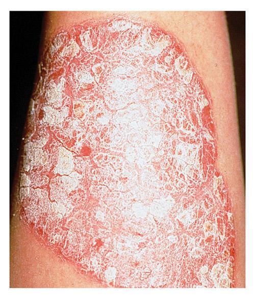 Psoriasis Describe this picture.