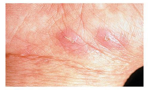 Scabies What is the cause of