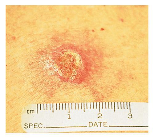 Skin cancer Basal cell carcinoma What is distinctive about this type