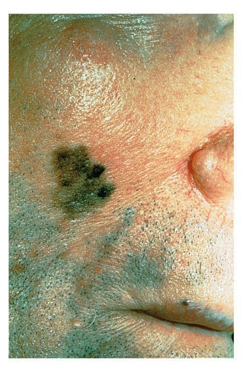 Skin cancer Malignant melanoma How is malignant melanoma different from the