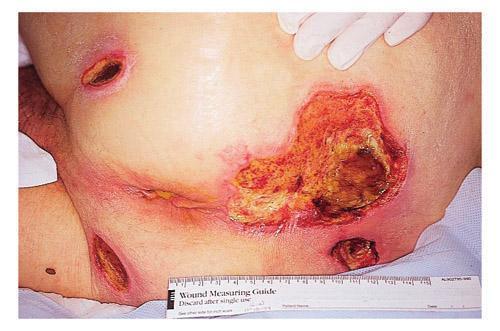 Skin lesion: Decubitus ulcer What is
