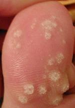 warts What causes warts?