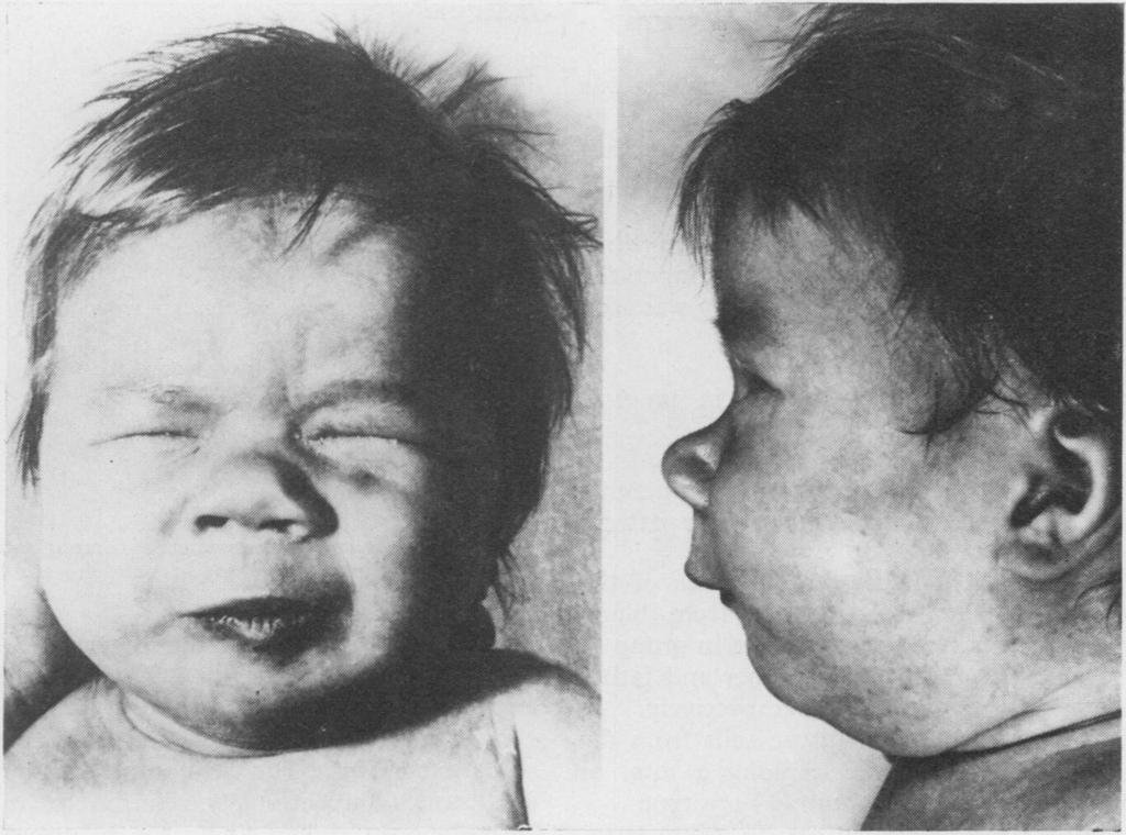 FIG. 1. The proposita at one month of age, showing micrognathia and rather low-set ears. deviating traits were seen (Fig.