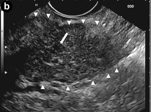 Case Series We present seven patients who were admitted to our Gastroenterology