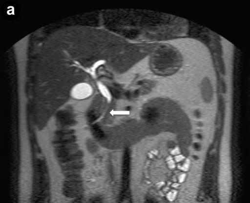 A diagnosis of autoimmune pancreatitis was histologically proven in all cases.