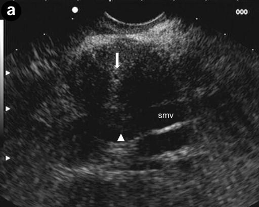 A 24-year-old man presenting with jaundice and elevated levels of IgG4 (366