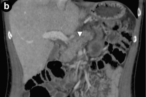 3 mm (Image 1b, arrow), measured with calipers (Image 1c, arrow). Hyperechoic septa were well visible in the enlarged gland.