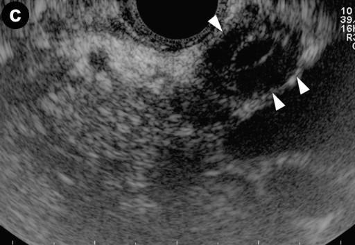with an ill-defined hypodense area (arrow) (Image 5a).
