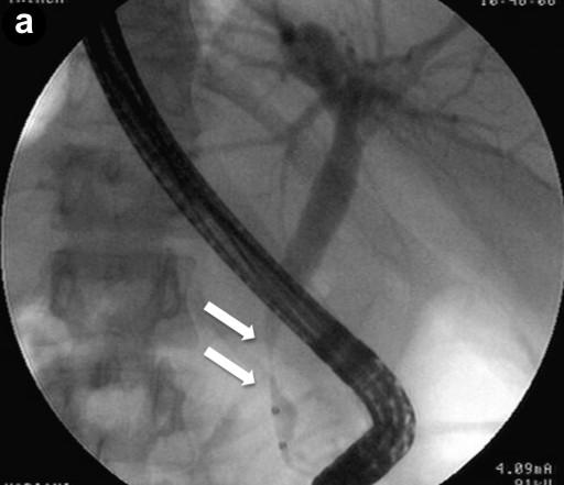 Image 6. echopoor echotexture and hyperechoic septa; the common bile duct, containing the stent, showed a three-layered, sandwich-pattern and thickening of the wall (arrowheads).