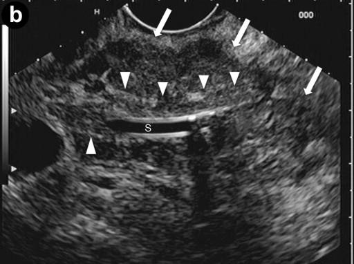 Transabdominal US and CT showed an enlarged pancreatic head, slightly dilated intra-hepatic bile ducts with a stricture of the intra-pancreatic common bile duct, and a distal focal stricture of the