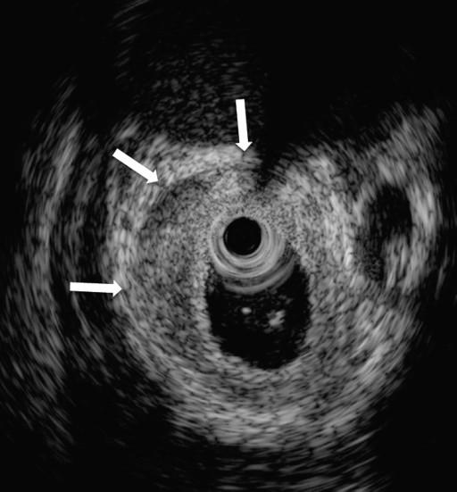 parenchymal, ductal, vascular and nodal EUS data, together with guided tissue sampling, can be pivotal in the diagnosis of this complex pancreatic disorder.