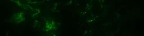 transplant biopsy Immunofluorescence GBM Mesangium