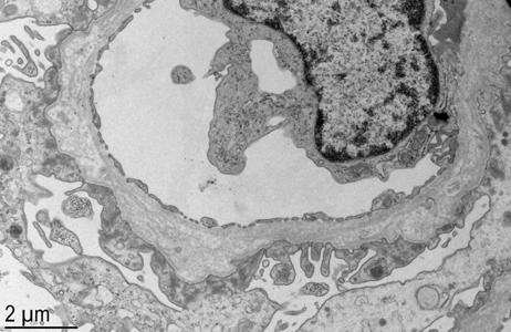 capillary basement membrane multilaminations in kidney