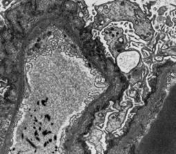 Am J Surg Pathol. 1999 Apr;23(4):437-42. Diffuse glomerular basement membrane lamellation in renal allografts from pediatric donors to adult recipients.